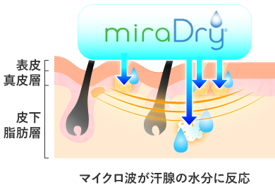 AdeBミラドライとは説明2