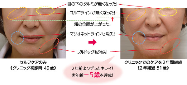 AdeBサーマクール治療例