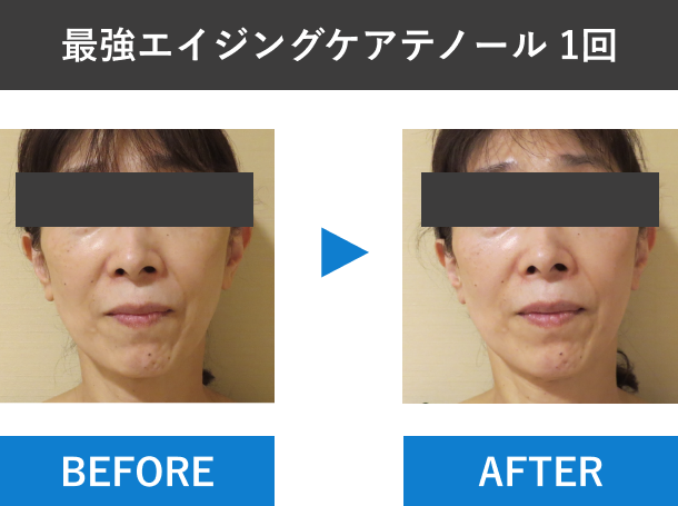 テノール症例　正面