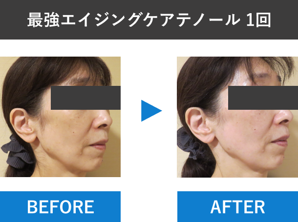 テノール症例　横