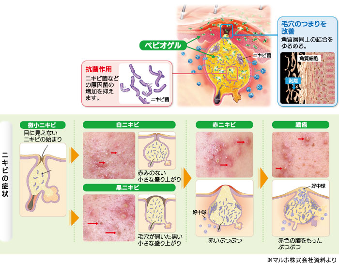 デュアック 配合 ゲル 効果