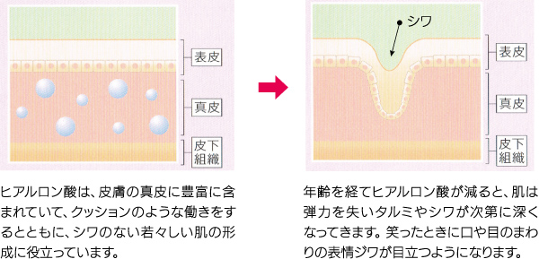 ãã¢ã«ã­ã³é¸ã®ã¡ã«ããºã 