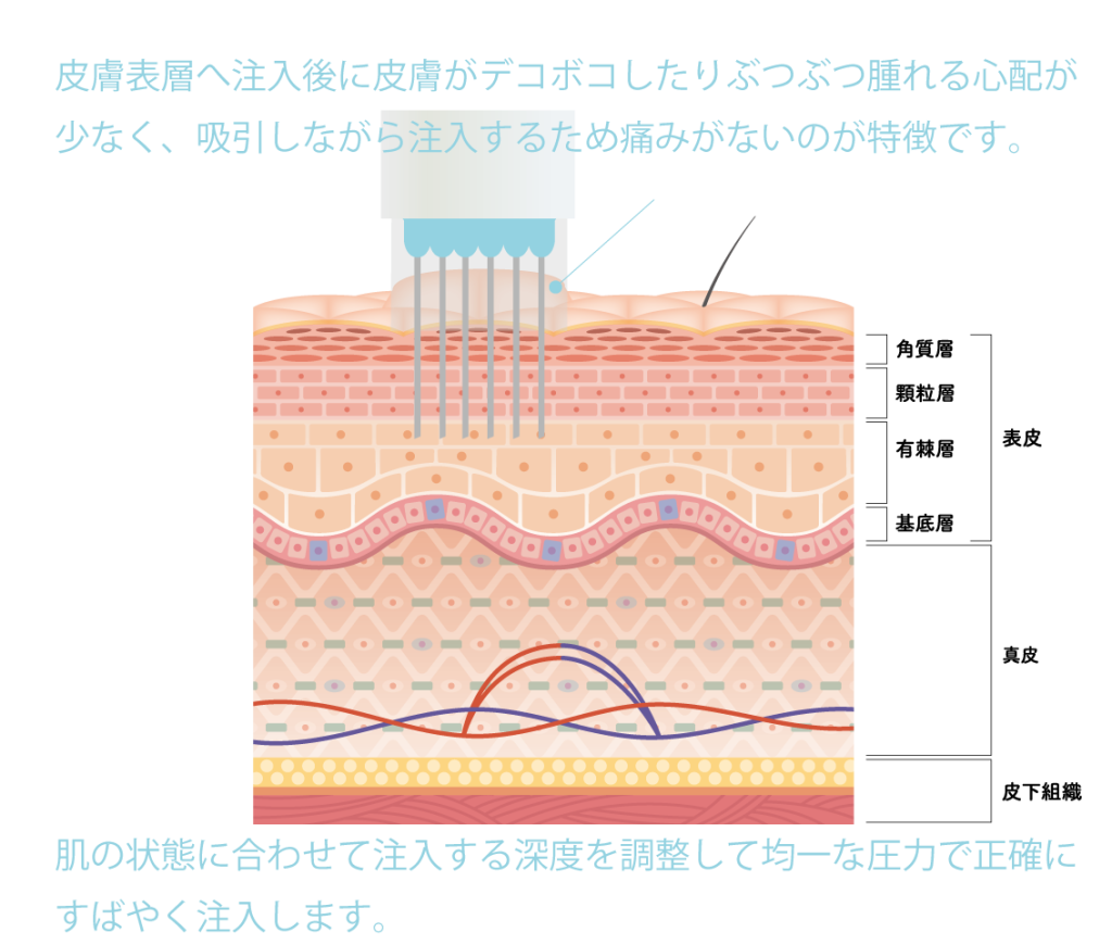 水光注射