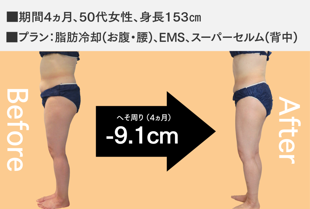 脂肪冷却事例2
