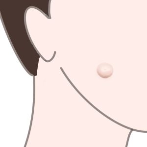 顔の粉瘤