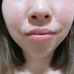 赤ら顔