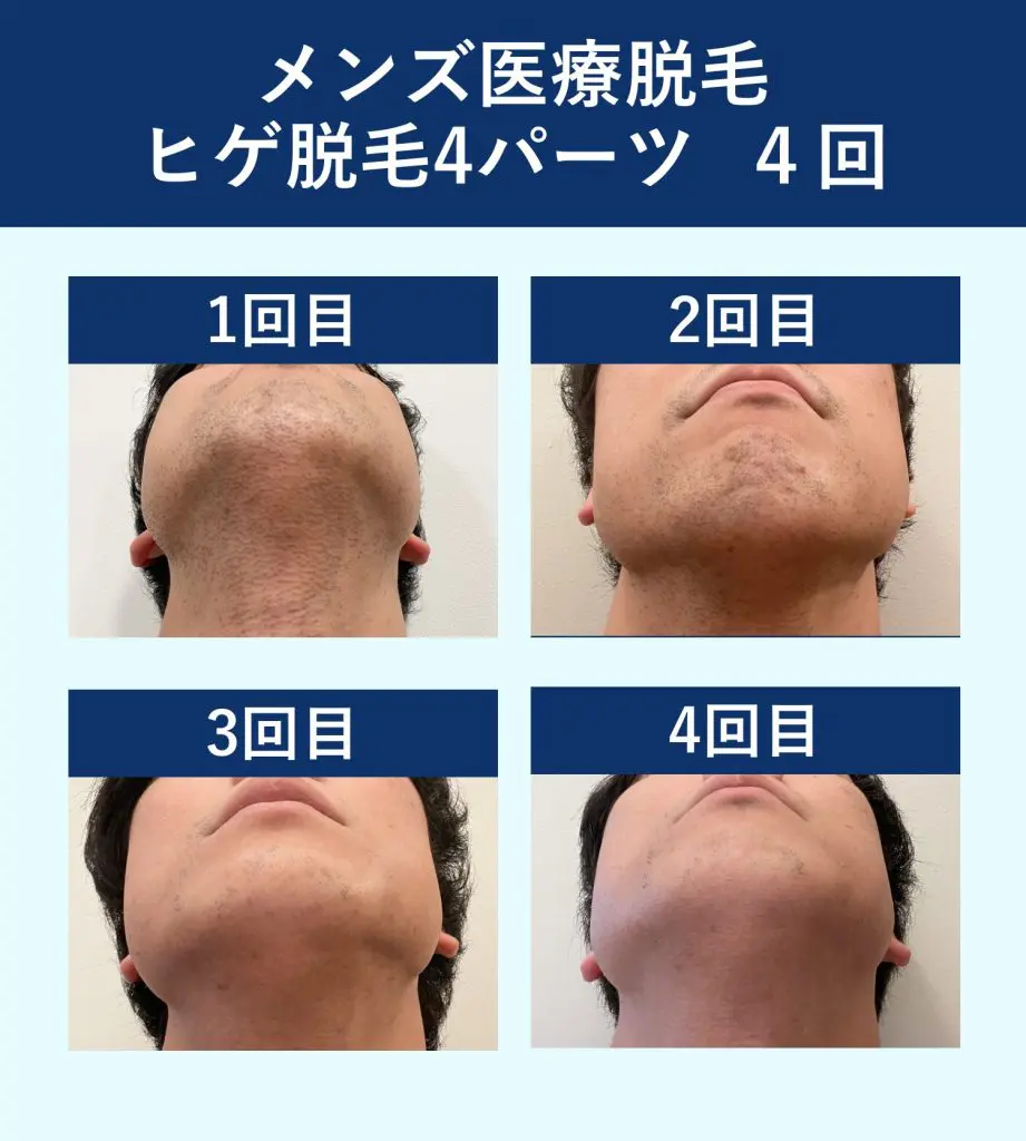 メンズヒゲ脱毛 - 秋田市の美容皮膚科 AdeBクリニック
