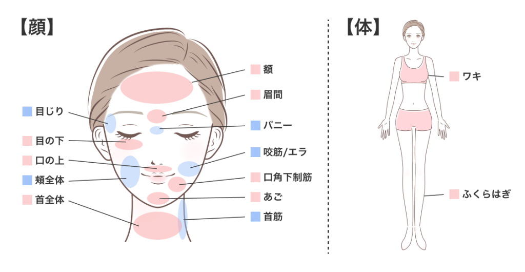 ボトックス部位全身（肩なし）