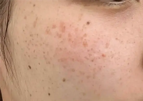 シミ - 秋田市の美容皮膚科 AdeBクリニック