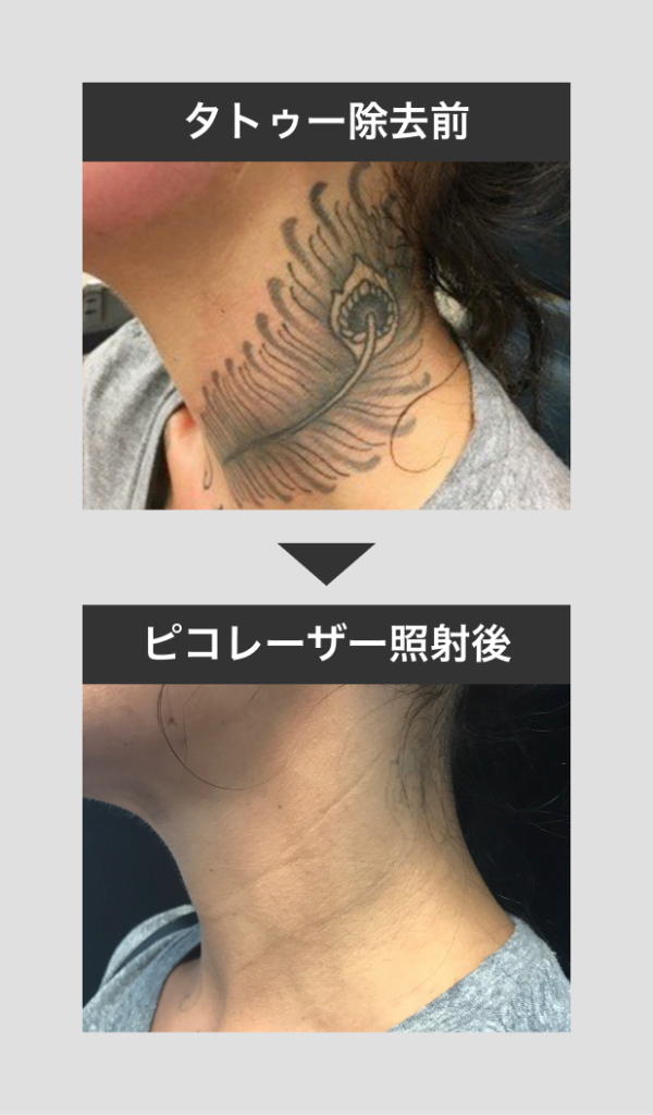 タトゥー（刺青）除去 - 秋田市の美容皮膚科 AdeBクリニック