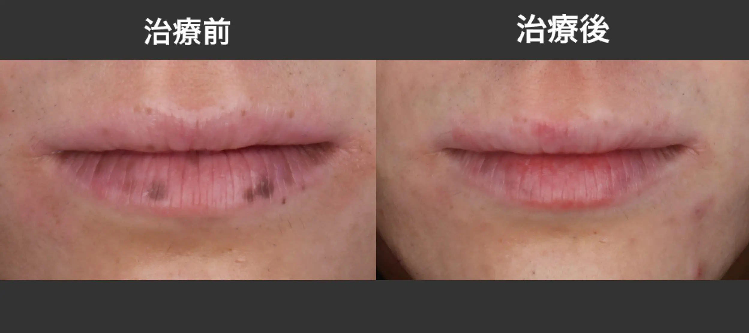 唇のシミ - 秋田市の美容皮膚科 AdeBクリニック