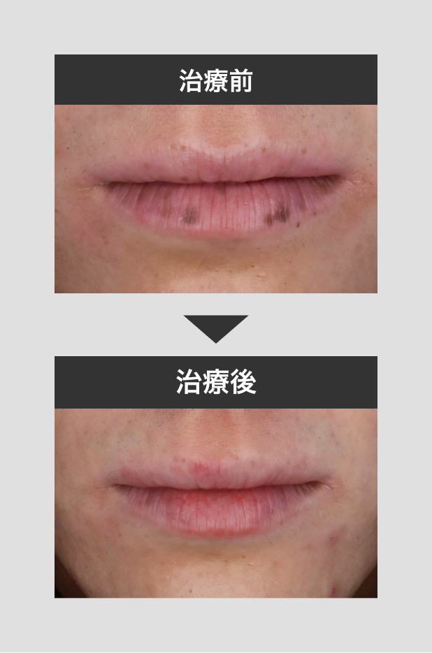 ノーマル唇sample 唇のシミ - 秋田市の美容皮膚科 AdeBクリニック