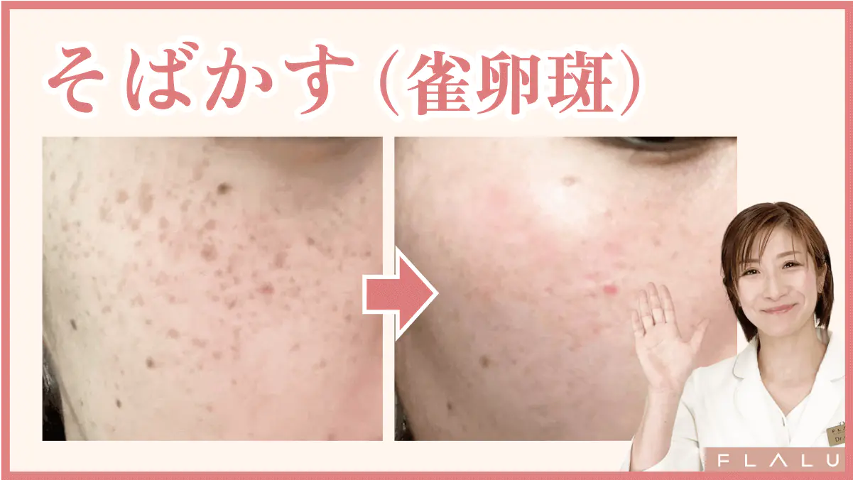 そばかすレーザー