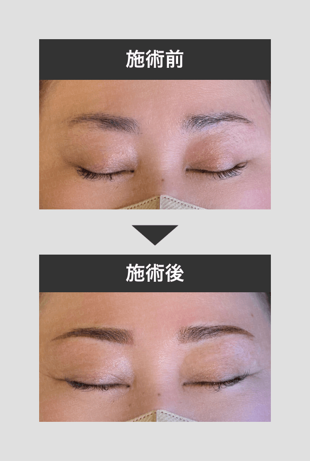 アートメイク（眉・アイライン・唇・ヘアライン） - 秋田市の美容皮膚