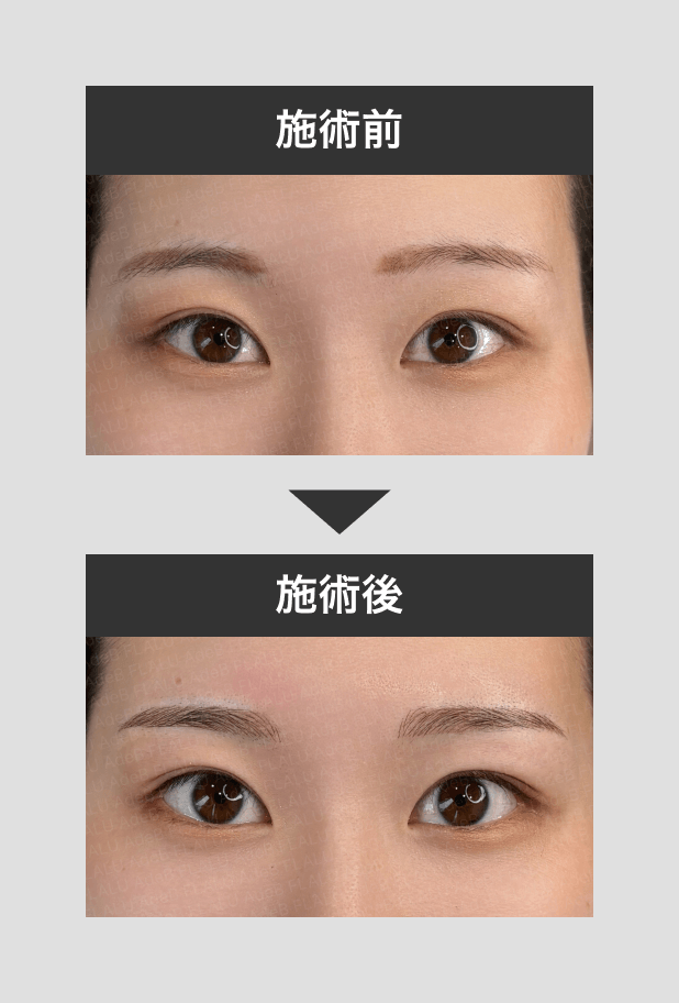 アートメイク（眉・アイライン・唇・ヘアライン） - 秋田市の美容皮膚