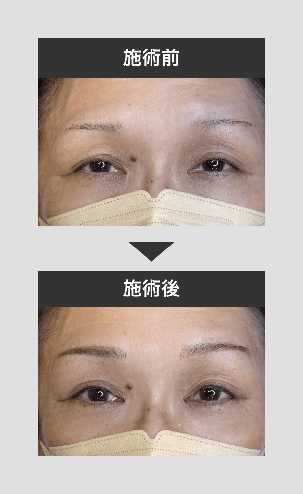 アートメイク_眉_2