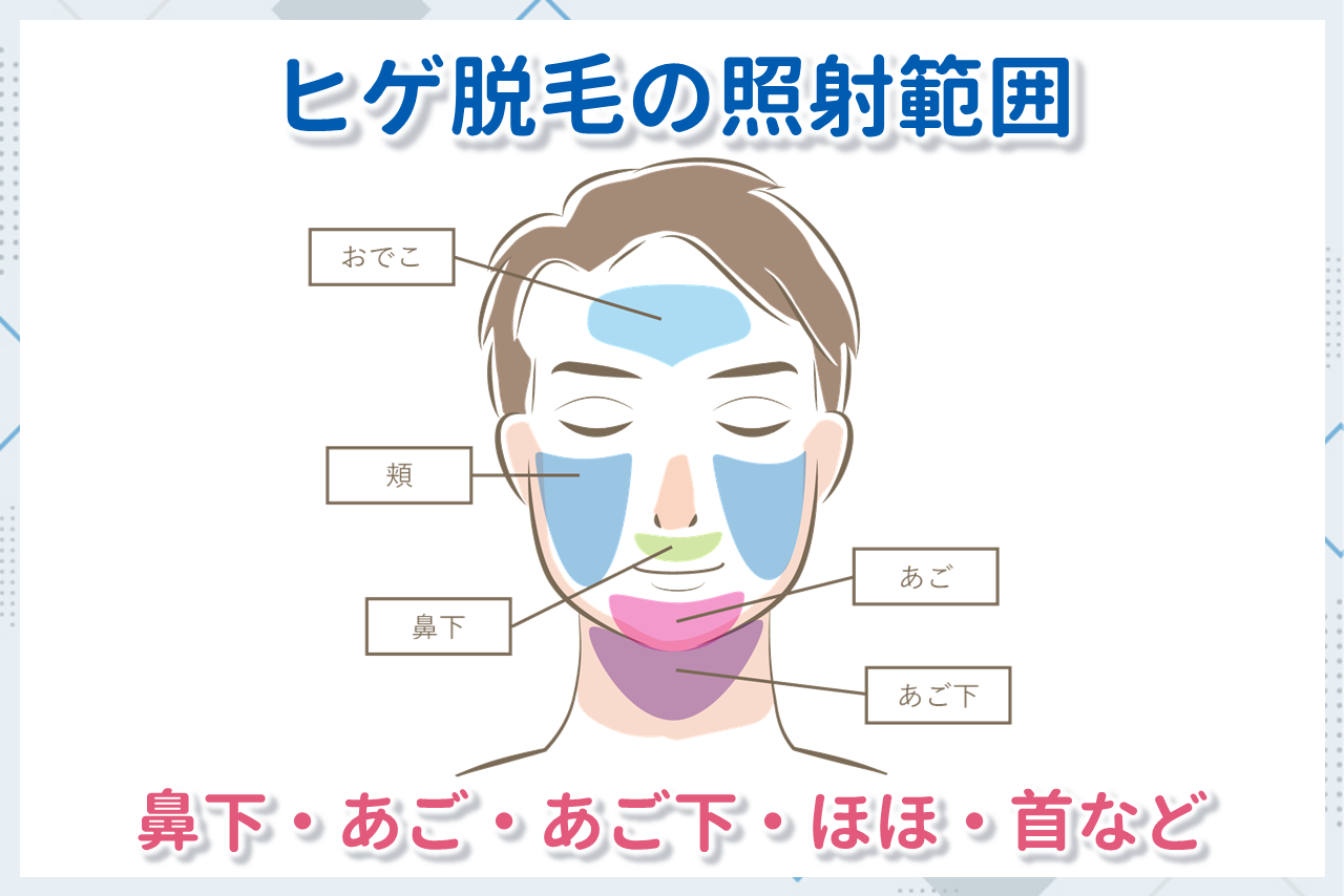 メンズヒゲ脱毛の照射範囲