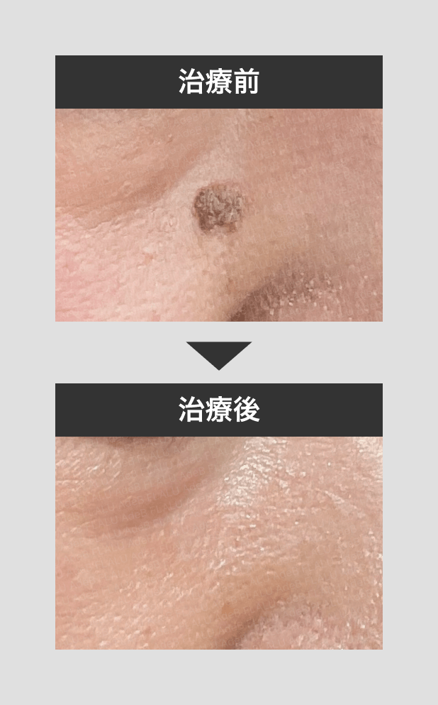 症例写真 - 秋田市の美容皮膚科 AdeBクリニック