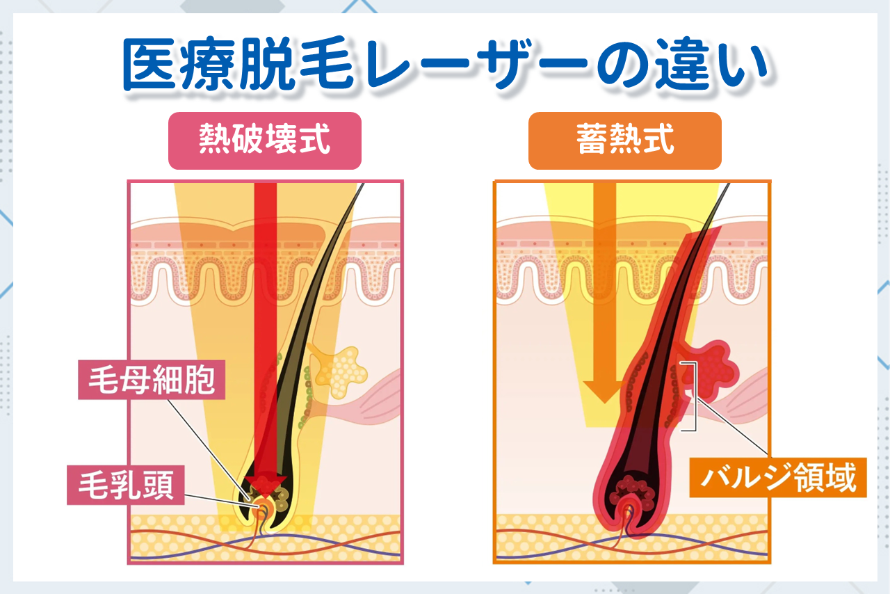 脱毛機の違いを知る