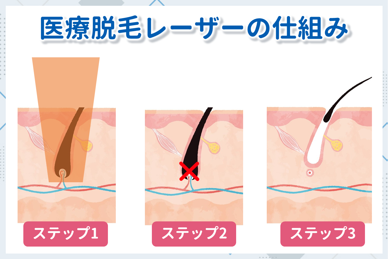 医療脱毛の仕組み