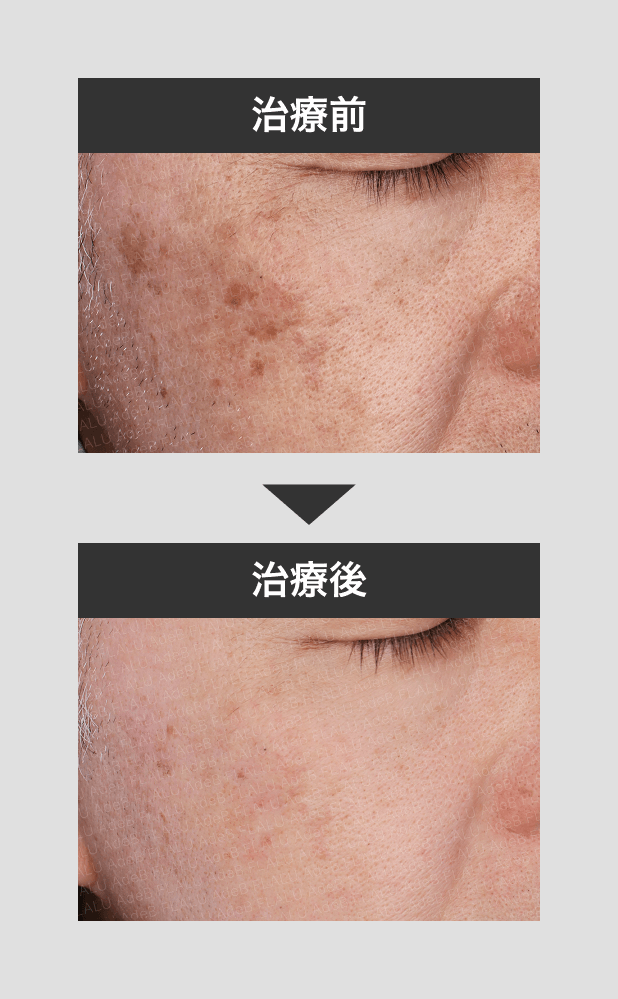 シミレーザー_1060代男性_2