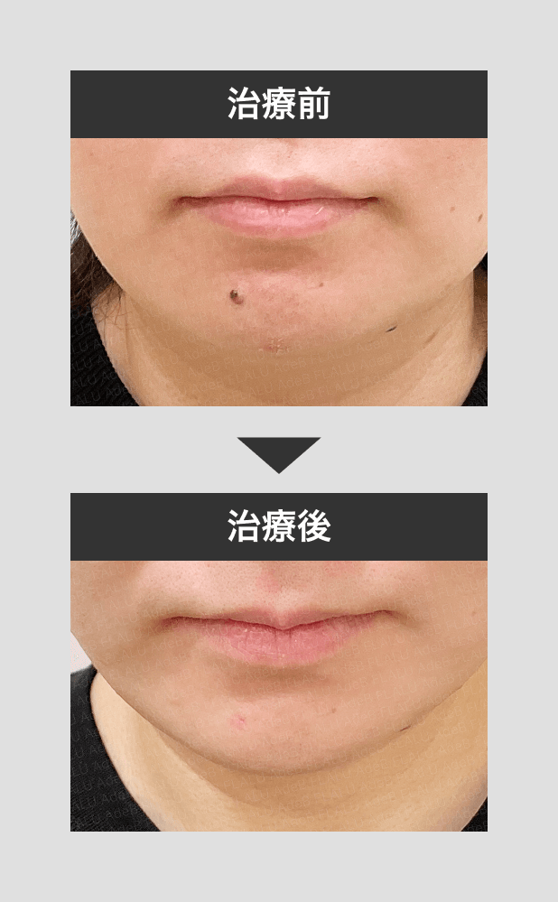 症例写真 - 秋田市の美容皮膚科 AdeBクリニック