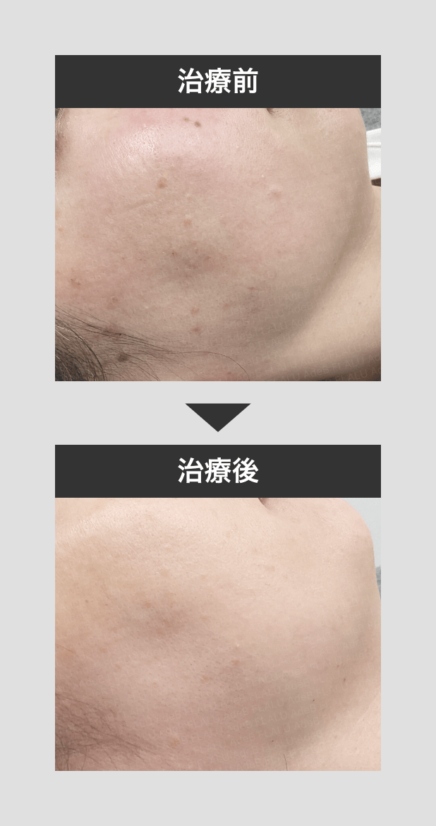 顔イボ_症例2