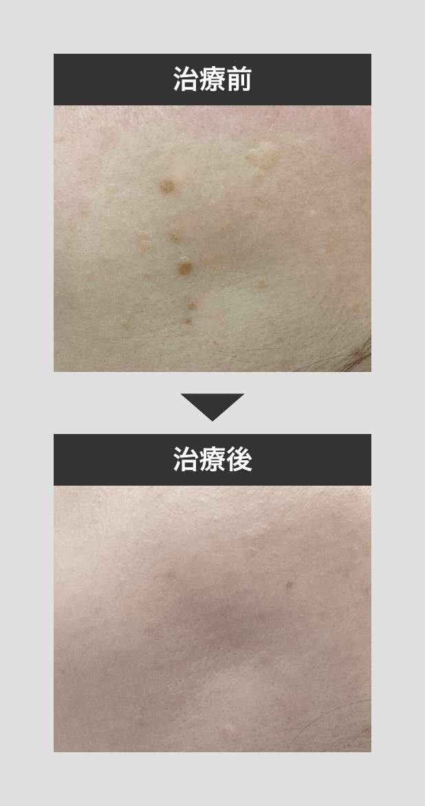 顔イボ_症例1