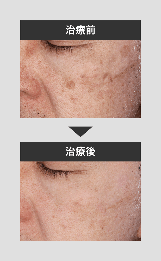 シミレーザー10_60代男性_1