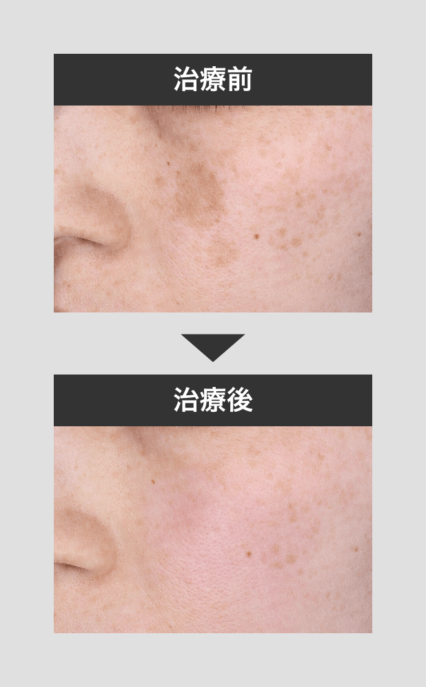 症例写真 - 秋田市の美容皮膚科 AdeBクリニック