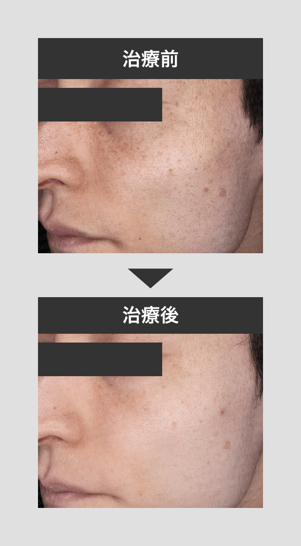 トーニング+VCパック_男性_肝斑治療