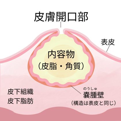 粉瘤構造図 (1)