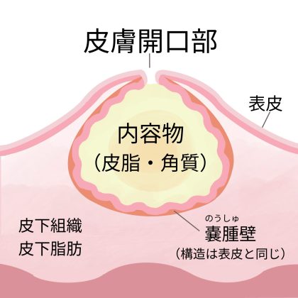 粉瘤構造図 (1) 粉瘤構造図 (1)