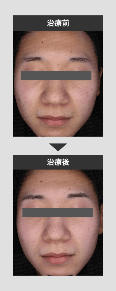 赤ら顔_通常写真_正面