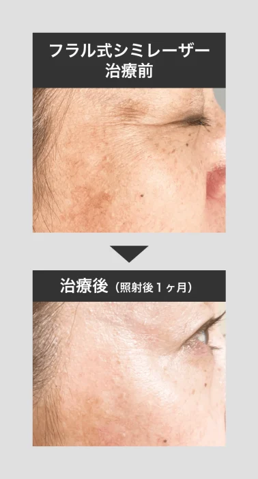フラル式