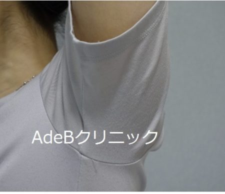 ミラドライ術後 ミラドライ術後