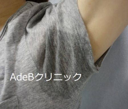 脇汗・多汗症 脇汗・多汗症